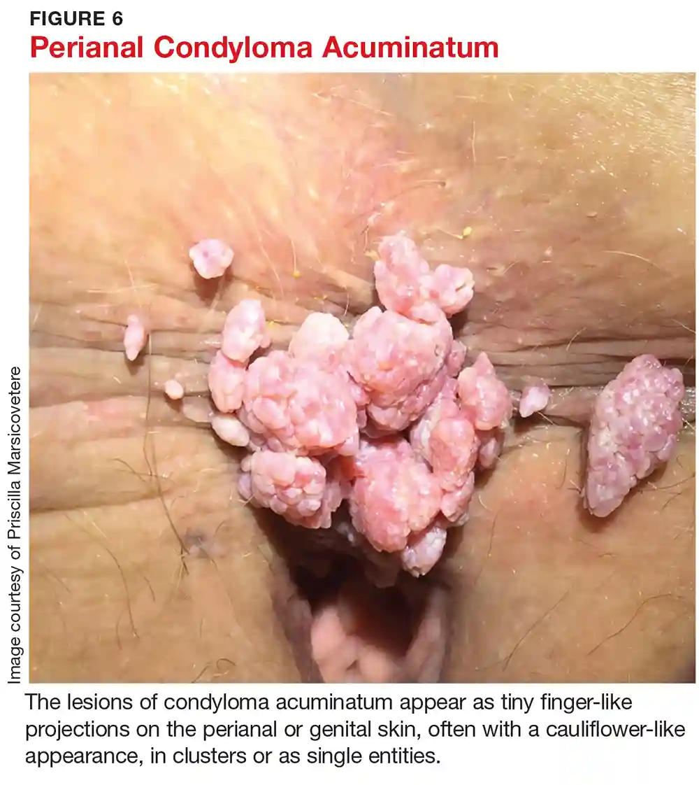زگیل های تناسلی به شکل گل کلم در ناحیه مقعد